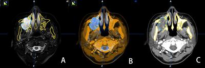 Accuracy of Mixed Reality Combined With Surgical Navigation Assisted Oral and Maxillofacial Tumor Resection